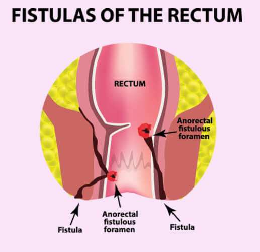 Reason Why Do Fissures Occur Again and Again?